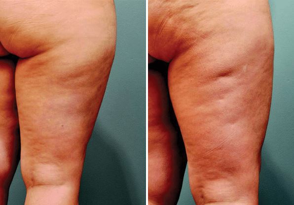 Celulitis
