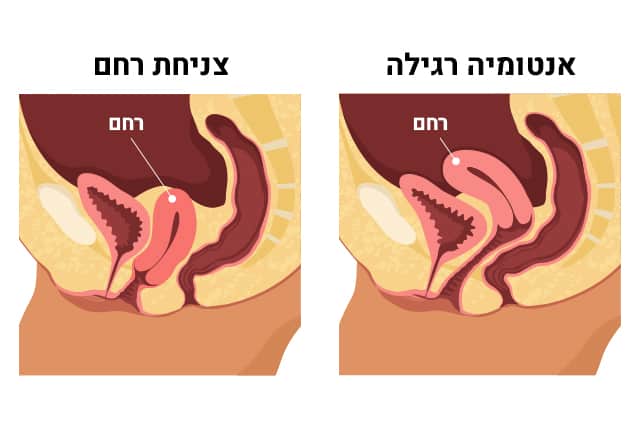 Prolapso uterino Imagen